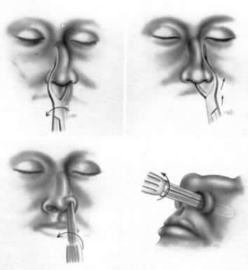 Frattura nasale
